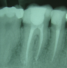 KORENINSKO ZDRAVLJENJE - ENDODONTIJA