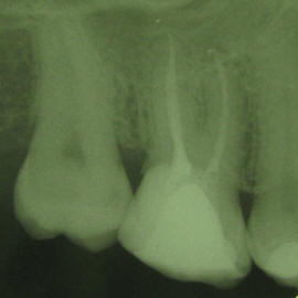 Po ponovnem zdravljenju koreninskih kanalov