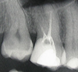 Slabo endodontsko zdravljenje